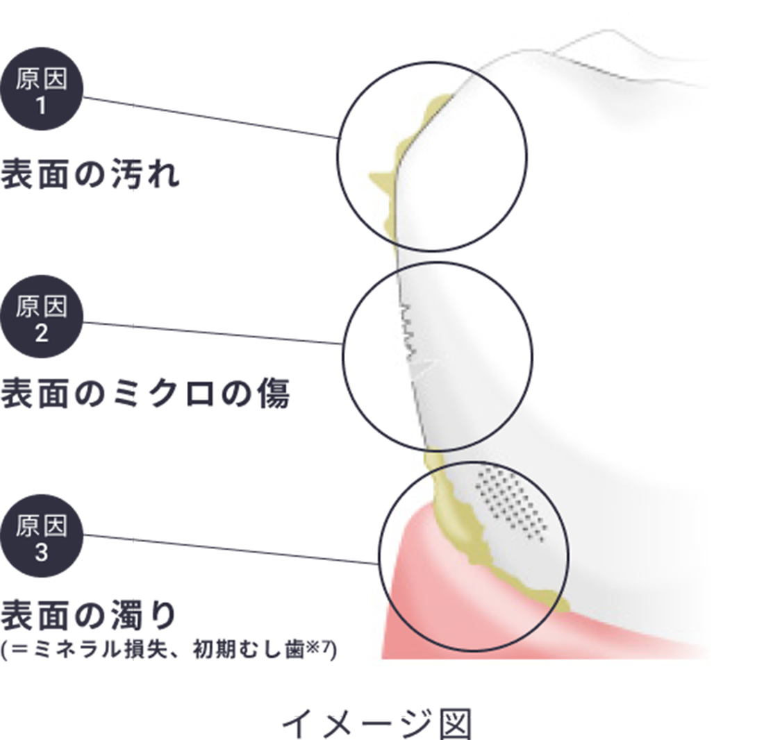 原因1表面の汚れ 原因2表面のミクロの傷 原因3表面の濁り(=ミネラル損失、初期むし歯※7)イメージ図