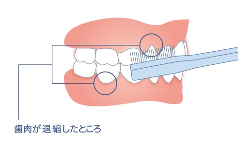 歯肉が退縮している場合