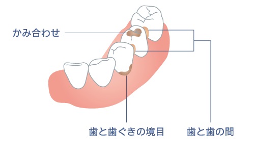 歯肉が退縮している場合